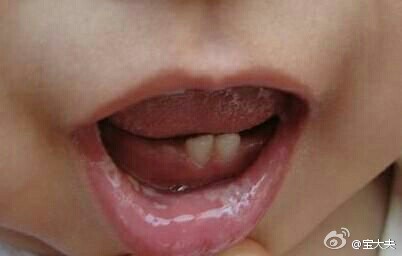 宝宝鹅口疮怎么治最有效,宝宝患有鹅口疮不要急