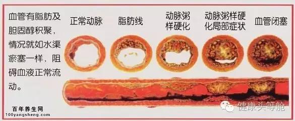 生鲜蔬果汁健康小百科之动脉硬化