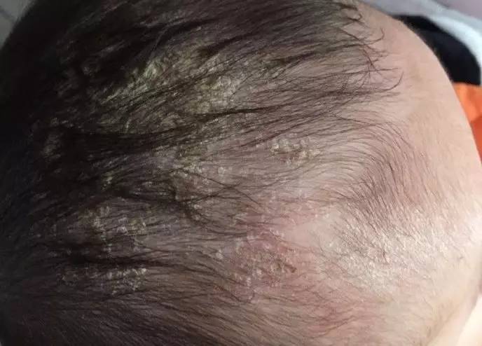 得了脂溢性皮炎会不会加重焦虑,得了脂溢性皮炎会有皱纹