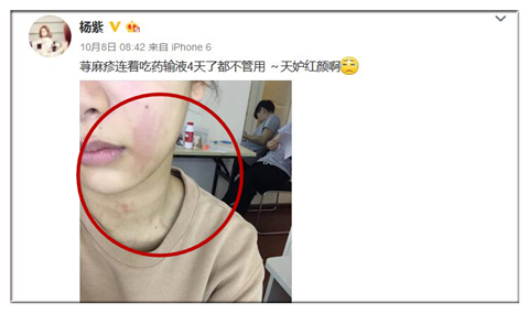 皮肤红肿瘙痒还有灼热感后起水泡,皮肤突然红肿发热瘙痒是怎么回事