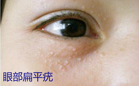 眼睛上有个小颗粒是什么,眼睛上的脂肪粒叫什么