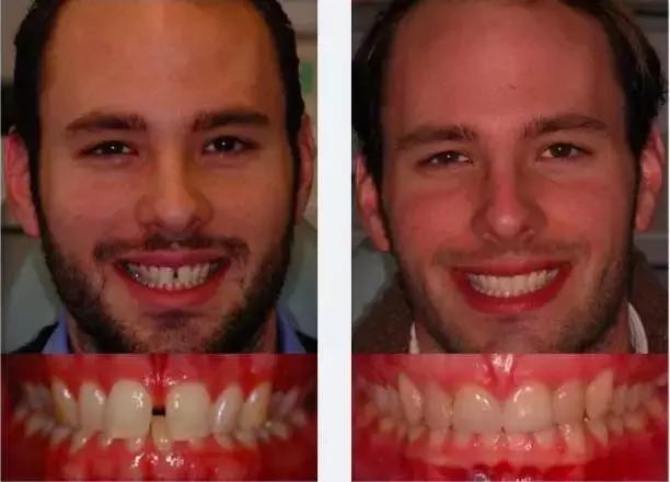 牙中间有缝怎么办,前牙有缝修复