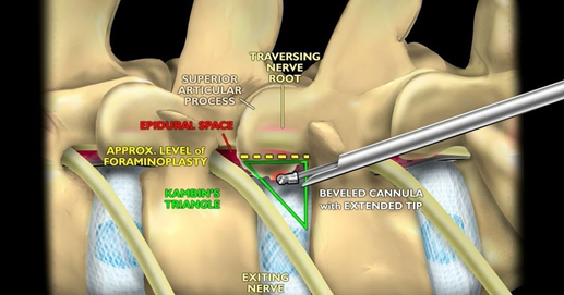 微创手术治疗腰椎间盘突出成功率,目前最热门腰椎微创技术椎间孔镜