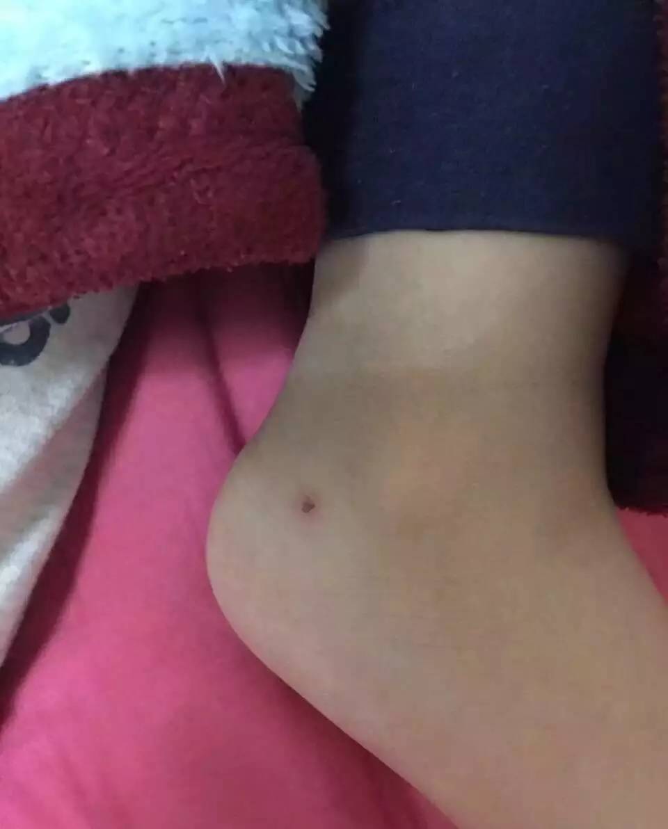 幼儿园孩子被针扎出红点,北京一幼儿园小朋友身上发现针眼