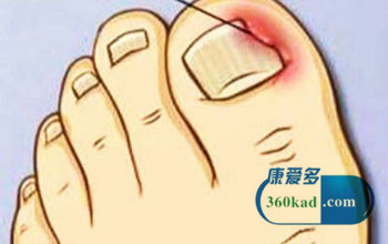 趾甲太短变甲沟炎怎么治疗,甲沟炎剪的太短也会发作吗