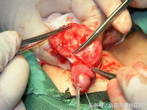 长了脂肪瘤有几种方法去掉,长了脂肪瘤怎么去除