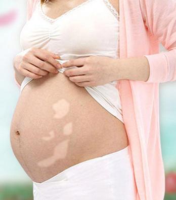 孕妇的白癜风怎么办,孕妇有白癜风会遗传给胎儿吗
