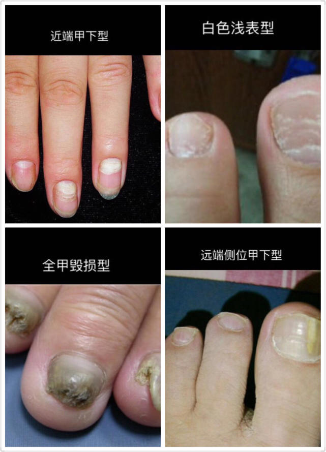 小孩手指甲分成两层是怎么回事,灰指甲指甲盖分离是好事还是坏事