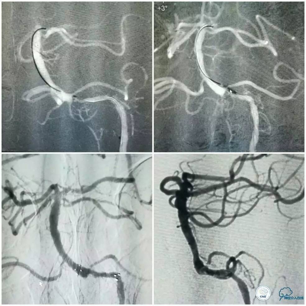 天坛周记|左椎V4段-基底动脉交界区狭窄的支架治疗