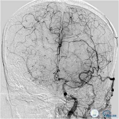 大脑中动脉侧支代偿正常标准,什么是左侧大脑中动脉代偿供血