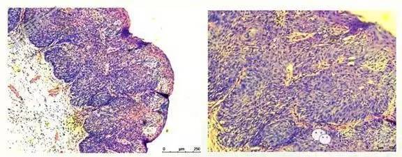 6个精彩病例带你领略早期食管癌的内镜下诊治