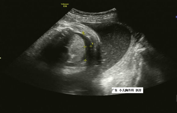 胎儿胸腔积液自己吸收的几率高吗,胎儿胸腔积液9mm严重吗