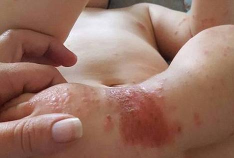 传疯了！只因家人一个习惯性的动作，1岁宝宝从头到脚染满病毒！