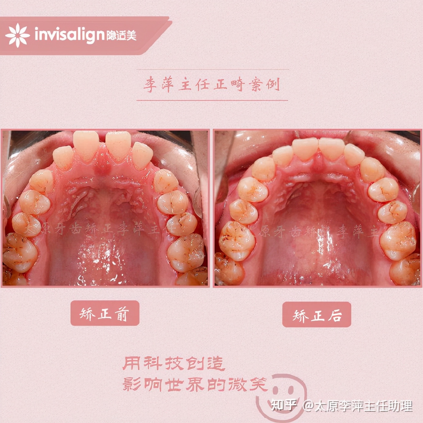 太原牙齿矫正靠谱吗,太原成人隐形牙套牙齿不齐