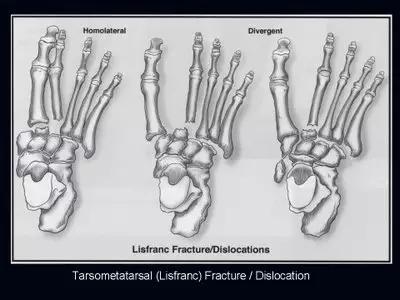 特殊骨折类型,特殊骨折体征