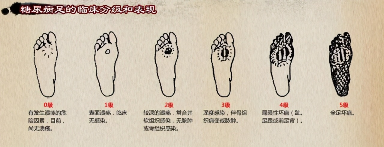 糖尿病足5级分型与0级糖尿病足的自我护理