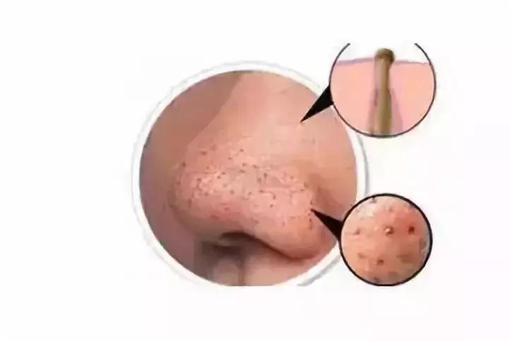 你的鼻头上有黑头怎么办,鼻尖上的黑头怎么处理