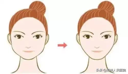 颧骨突出侧颜不好看怎么改善,颧骨宽太阳穴凹陷下颌骨宽改善