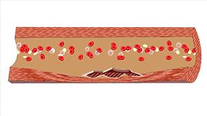 为什么高血压是无形的杀手,高血压是无形杀手吗