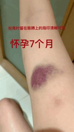 短跑名将张培萌被曝家暴,短跑名将张培萌殴打岳母被行拘