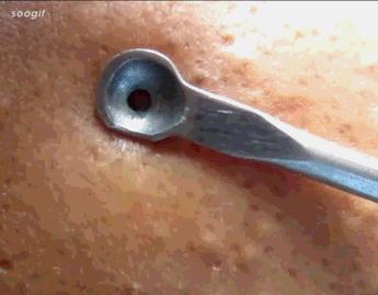 鼻子起痘都能挤出很多白色油脂,鼻子白色的痘痘挤出来有痘坑吗