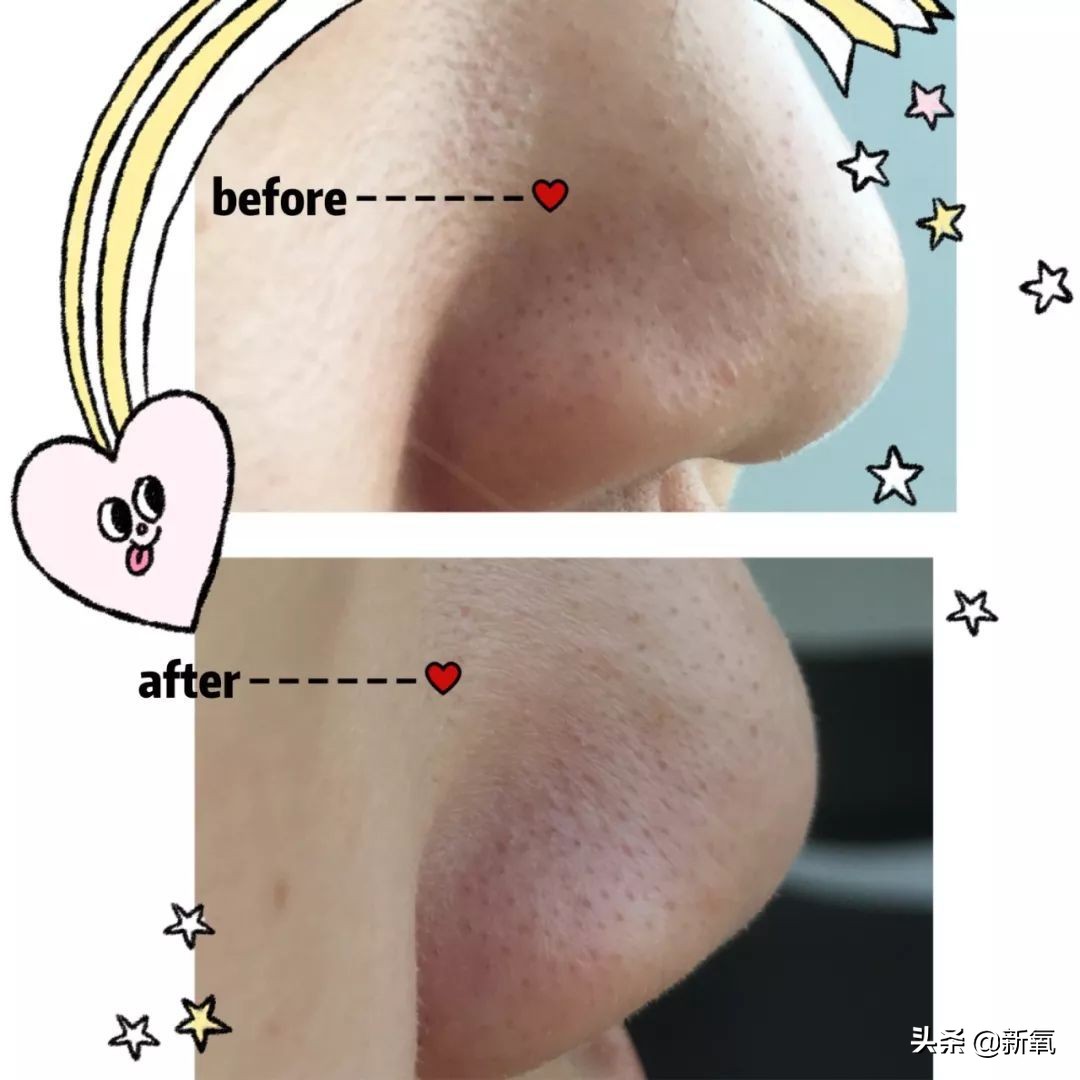 五分钟教你有效去黑头,最火去黑头收缩毛孔