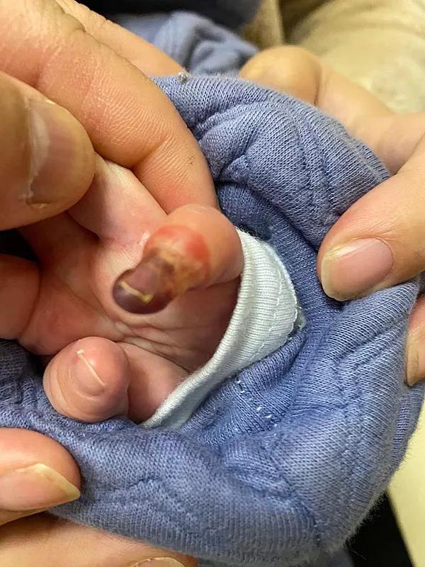 妈妈防止宝宝抓脸面具,出生婴儿防抓脸