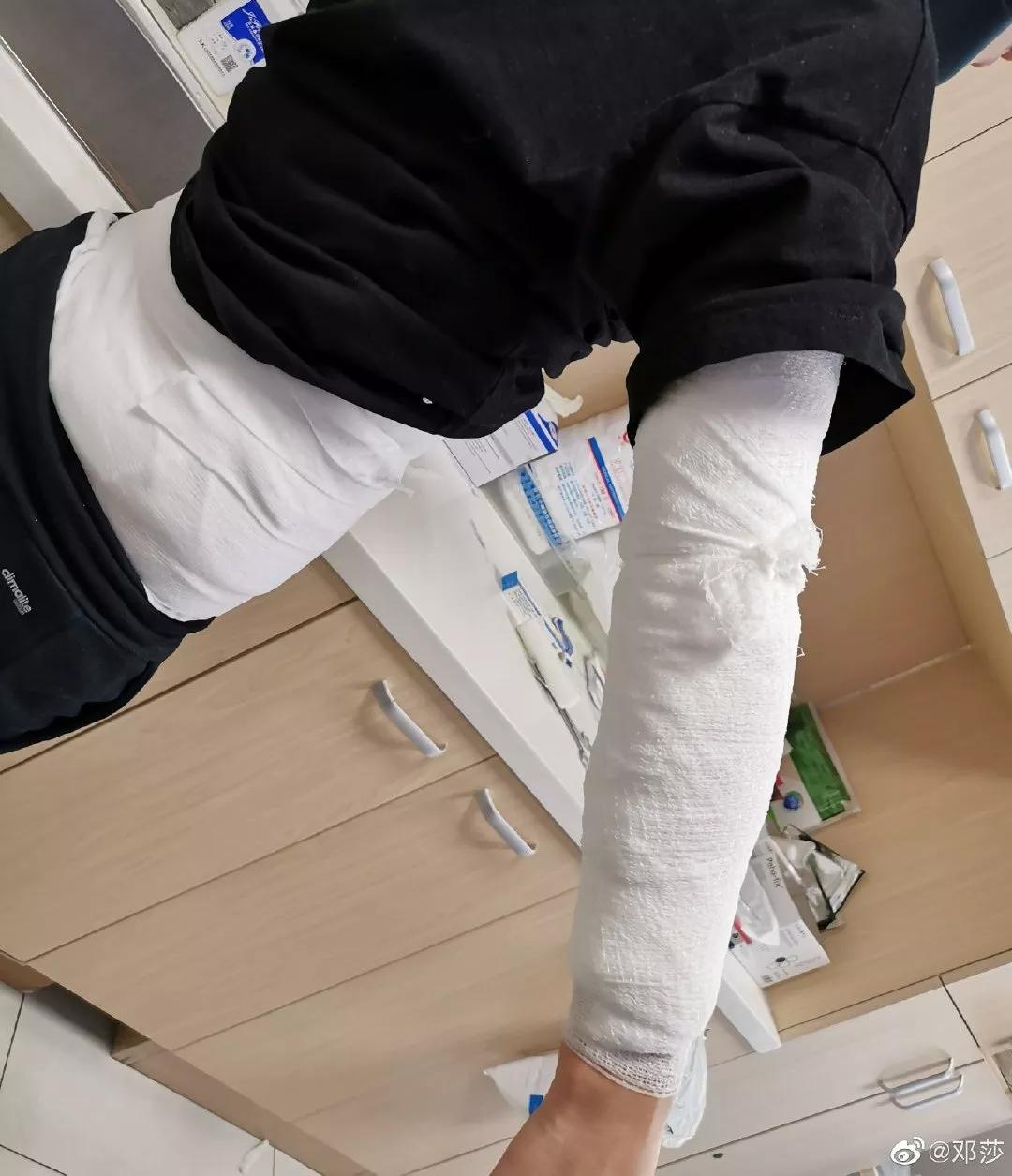 邓莎被烧伤原因,邓莎拔火罐被烧伤视频