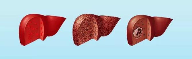 大三阳引起的肝硬化早期能治好吗,大三阳导致肝硬化怎么治疗