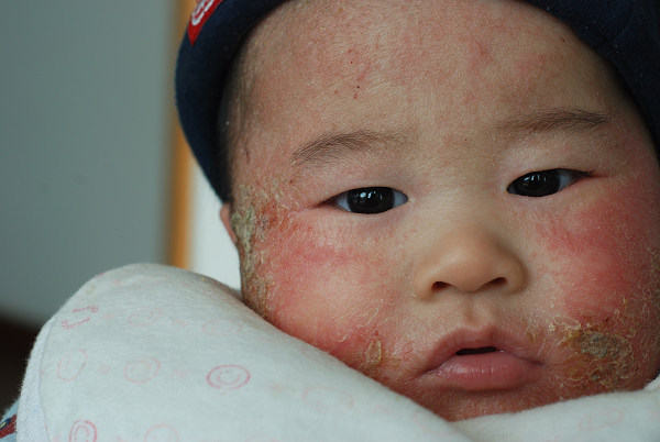 怎么预防宝宝湿疹的发生,如何预防宝宝湿疹最有效方法