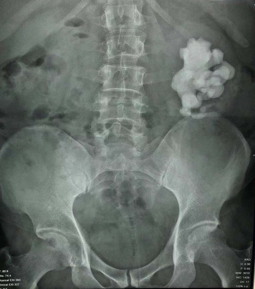 泌尿系统结石溶石方法,尿路结石有什么溶石特效药吗