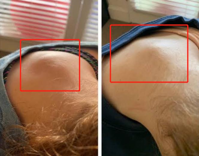 脖子后边的富贵包该怎么治疗,脖子后面的富贵包咋治呢