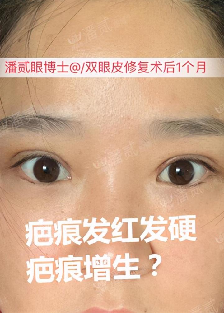 双眼皮修复要对医生说实话吗,双眼皮失败可以修复的几率有多大