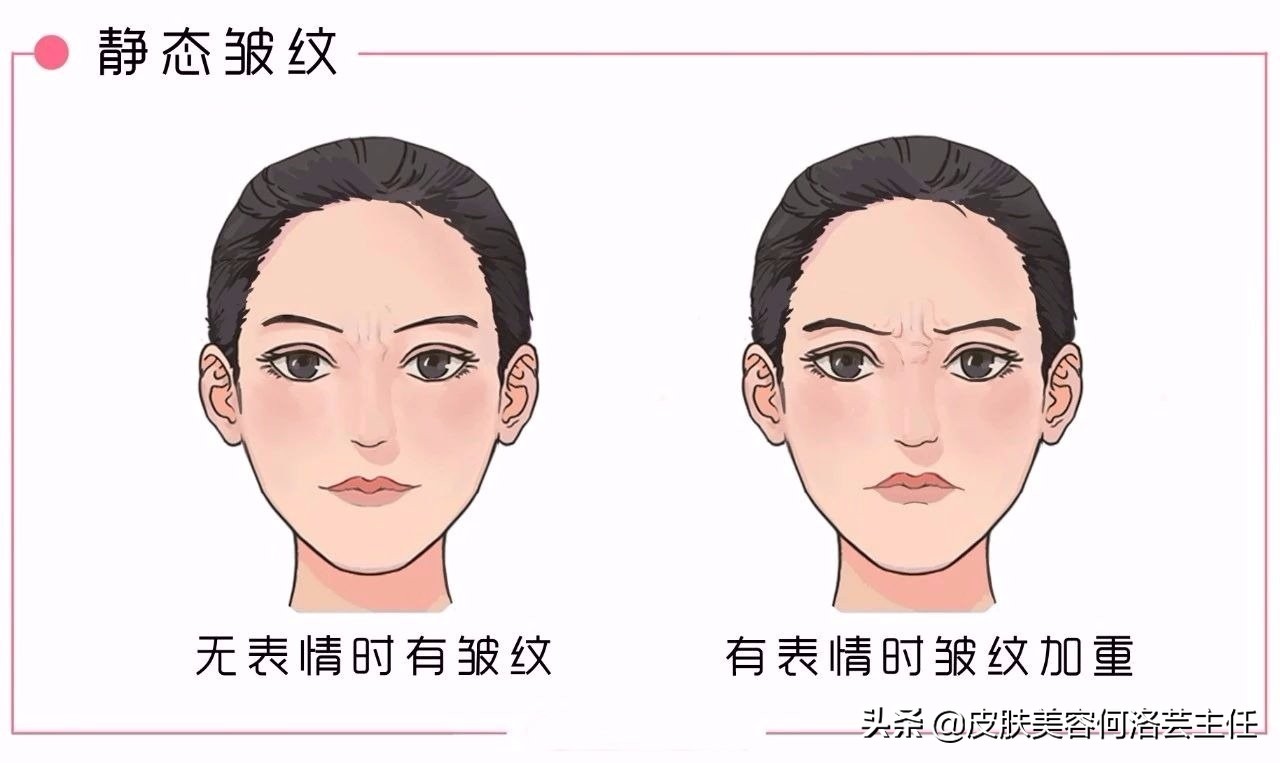 长皱纹多了用什么方法去皱纹最好,满脸皱纹最有效去皱方法