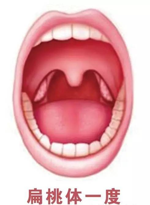 急性扁桃体炎引起的耳痛,急性扁桃体炎怎么缓解疼痛