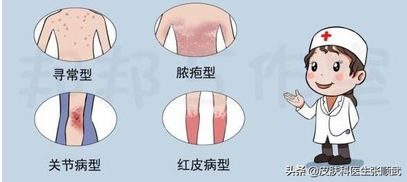 银屑病怎么治疗才好得快,看中医调理银屑病