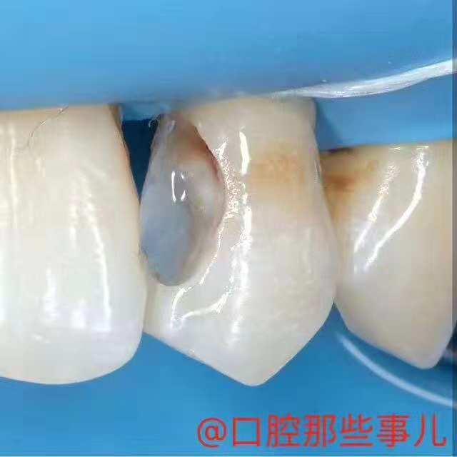 想要补个牙反而被磨了个大洞,大牙牙洞很大很深能补吗