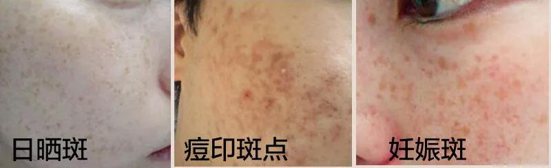 祛色斑的小窍门,色斑严重学会这几招省钱又有效
