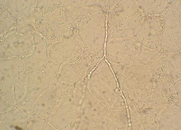 鑾妸绁炵粡鎬х毊鐐庡綋婀跨柟,鍒妸婀跨柟褰撶毊鑲ょ梾