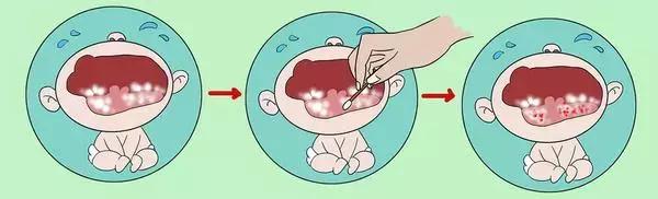预防鹅口疮的最佳方法,如何预防婴幼儿鹅口疮