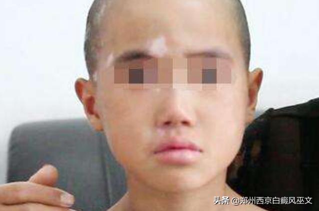 7岁男孩得了白癜风是谁害了他,7岁男孩白癜风是什么原因造成的