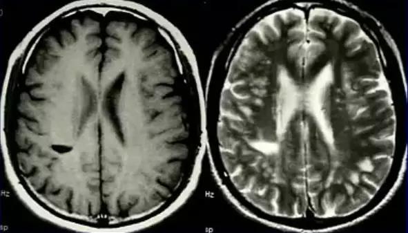 脱髓鞘病变是什么病怎么读,脱髓鞘病变的特征