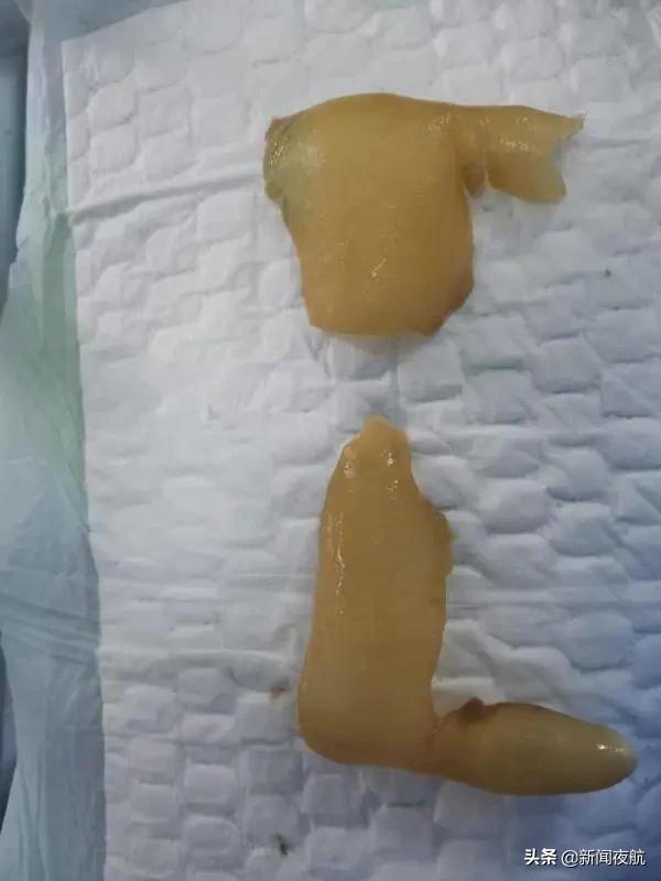 13岁男孩患罕见皮肤病,男孩得了罕见皮肤病