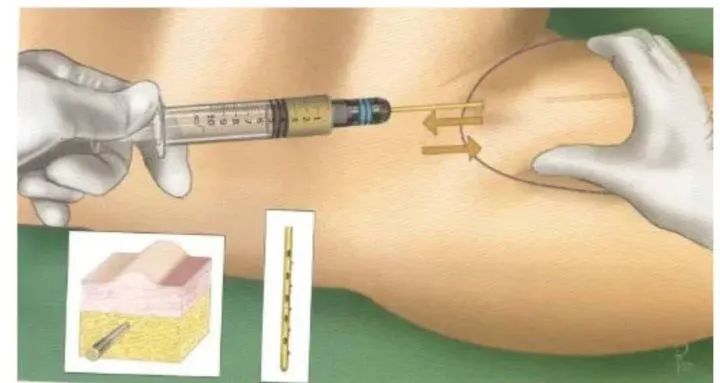 娄艺潇填充脂肪前后对比,娄艺潇填充前后对比