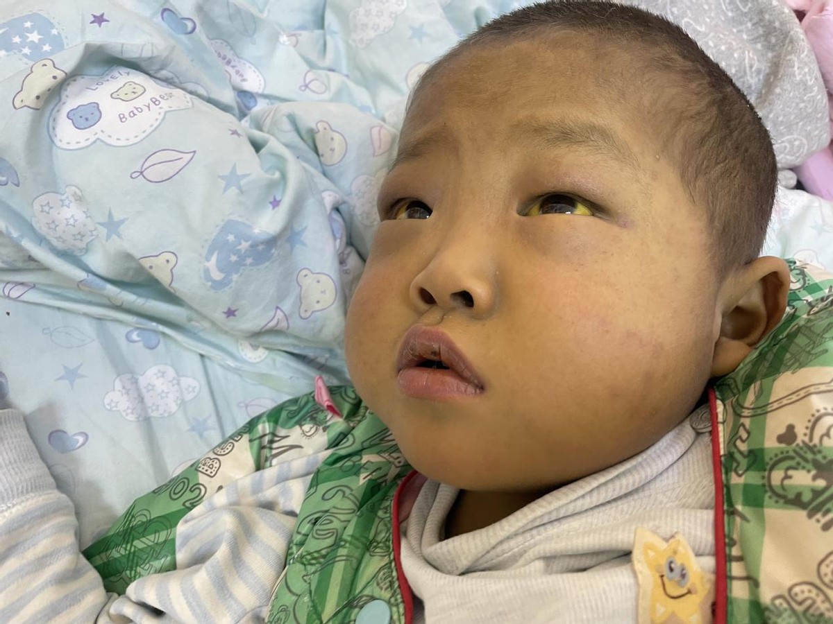 刚出生的小孩要换肝是什么病,小孩出生一星期眼睛黄