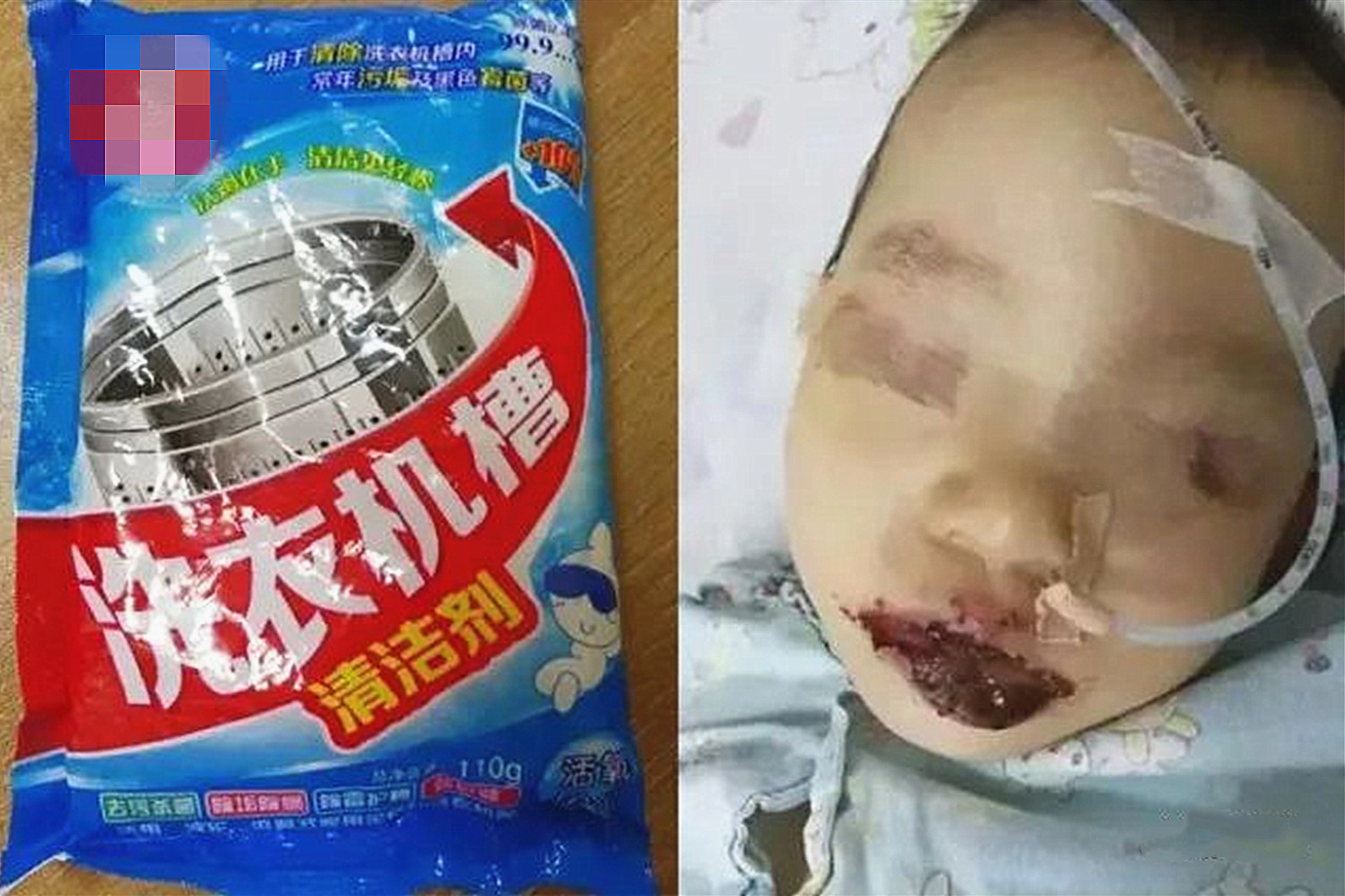 4岁女童误吞一角硬币怎么处理,4岁女童误吞5角硬币