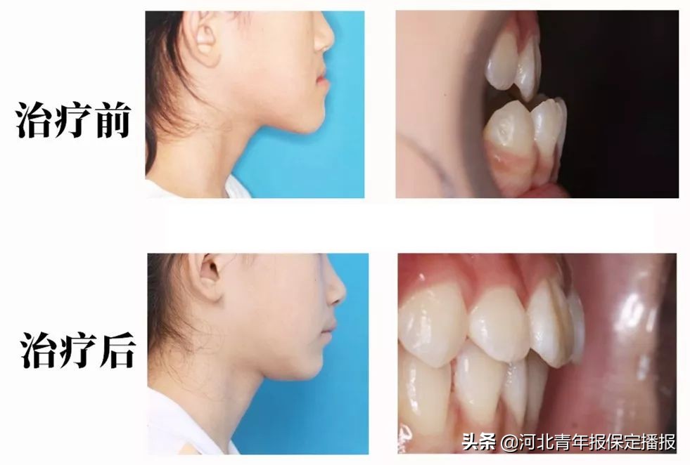 保定普通隐形牙套,保定隐形牙套矫正