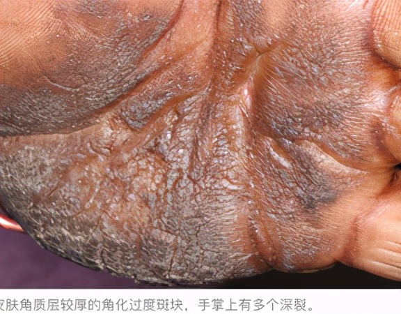 老年人脚底皮肤皲裂症原因是什么,更年期脚后跟皲裂是怎么回事