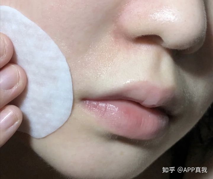 刷酸后黑头容易挤出来,刷酸后黑头多毛孔特别大了