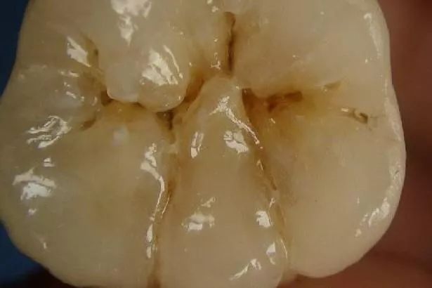 孩子有蛀牙但不疼需要补牙吗,孩子蛀牙了要不要刷牙